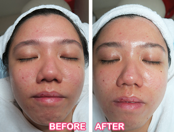 Before and After of Facial Hydration