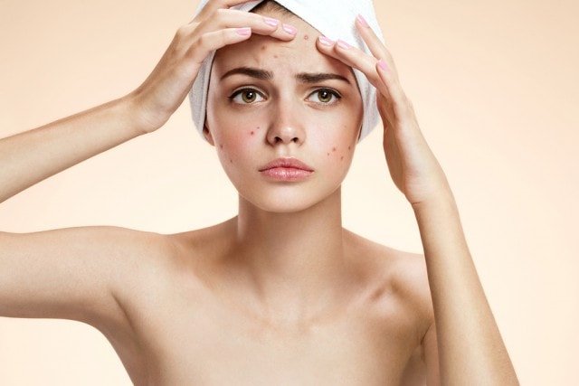 Acne treatment for different types of non inflamed acne in Singapore