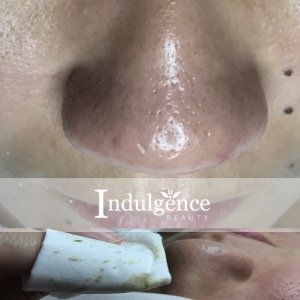 Acne extraction after