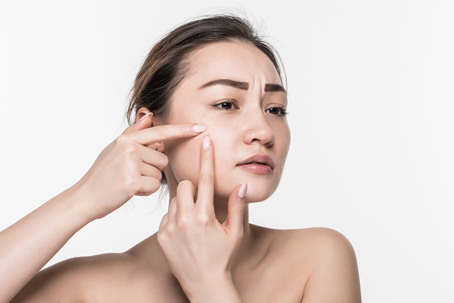 4 Ways To Rid of Acne Scars and Marks