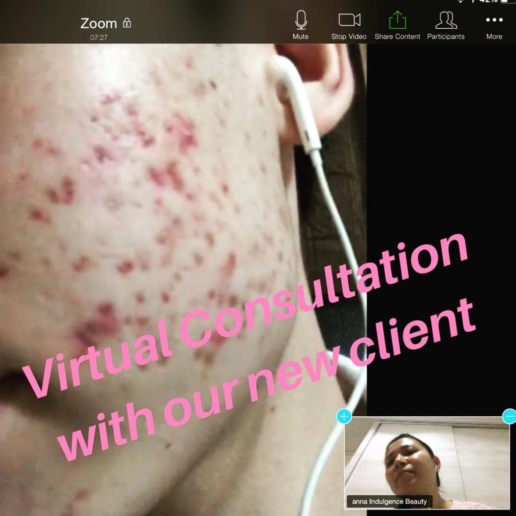 Acne Treatment Via Virtual Skin Consultation