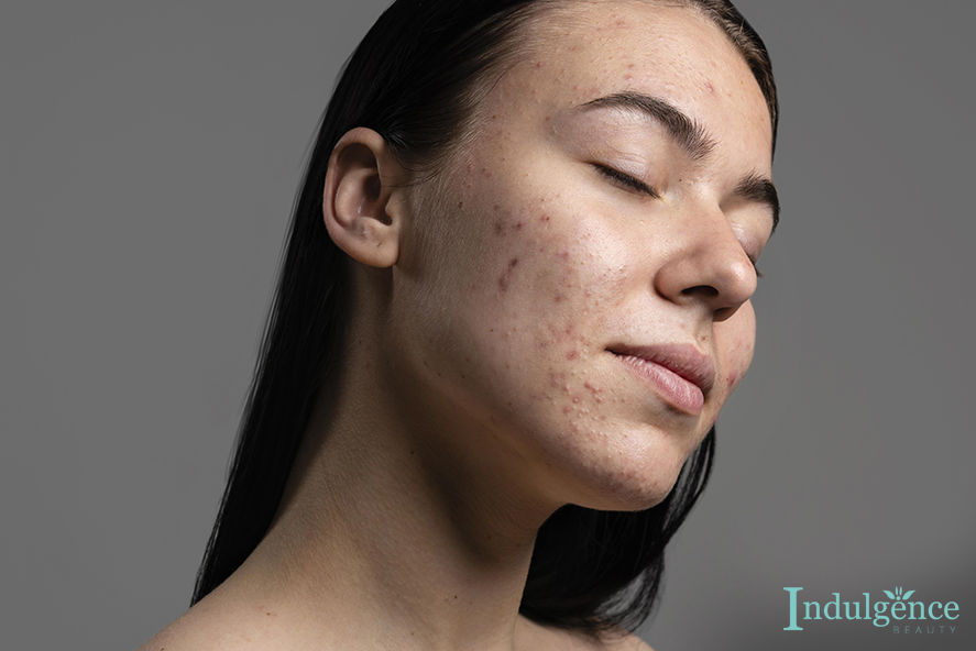 10 Simple Lifestyle Changes That Will Help To Improve Acne