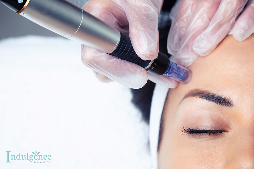 Microneedling Facial What Is It How It Works & The Benefits