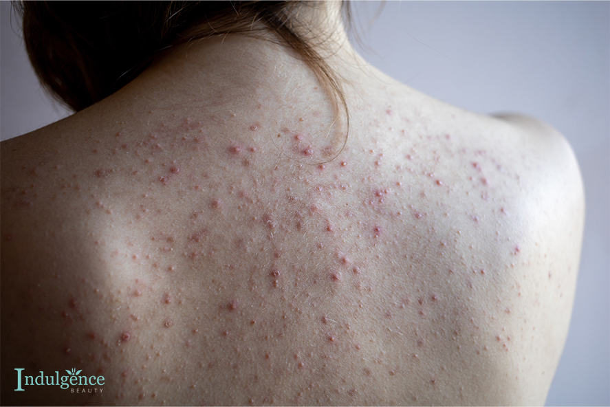 the effects of back acne