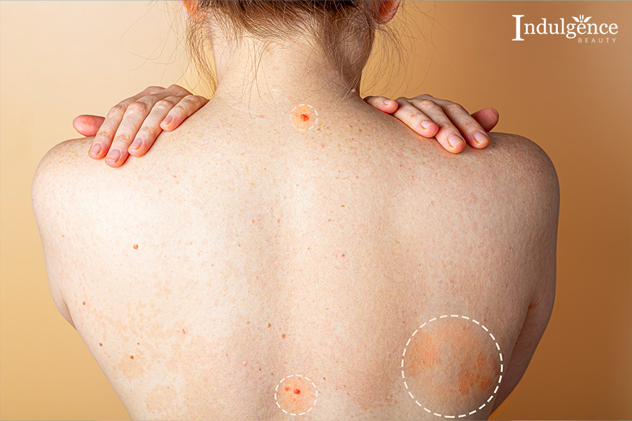 Light at the End of the Tunnel: Advanced Solutions for Back Acne