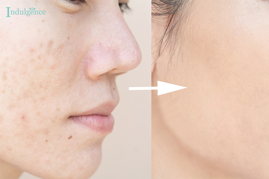 A Before and After Facial 